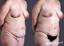 BodyTite™ - Before & After Photos