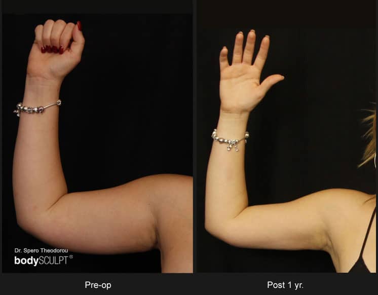 Scarless Female Arm Lift - Before & After Photos