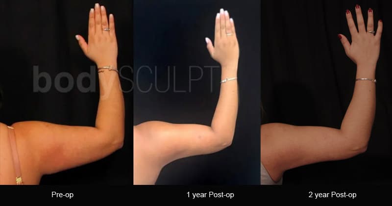 Scarless Female Arm Lift - Before & After Photos